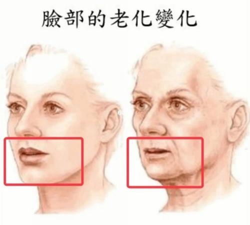 米揚麗格馬平山醫生采用PLLA艾維嵐在口周年輕化方面的成果(圖7)