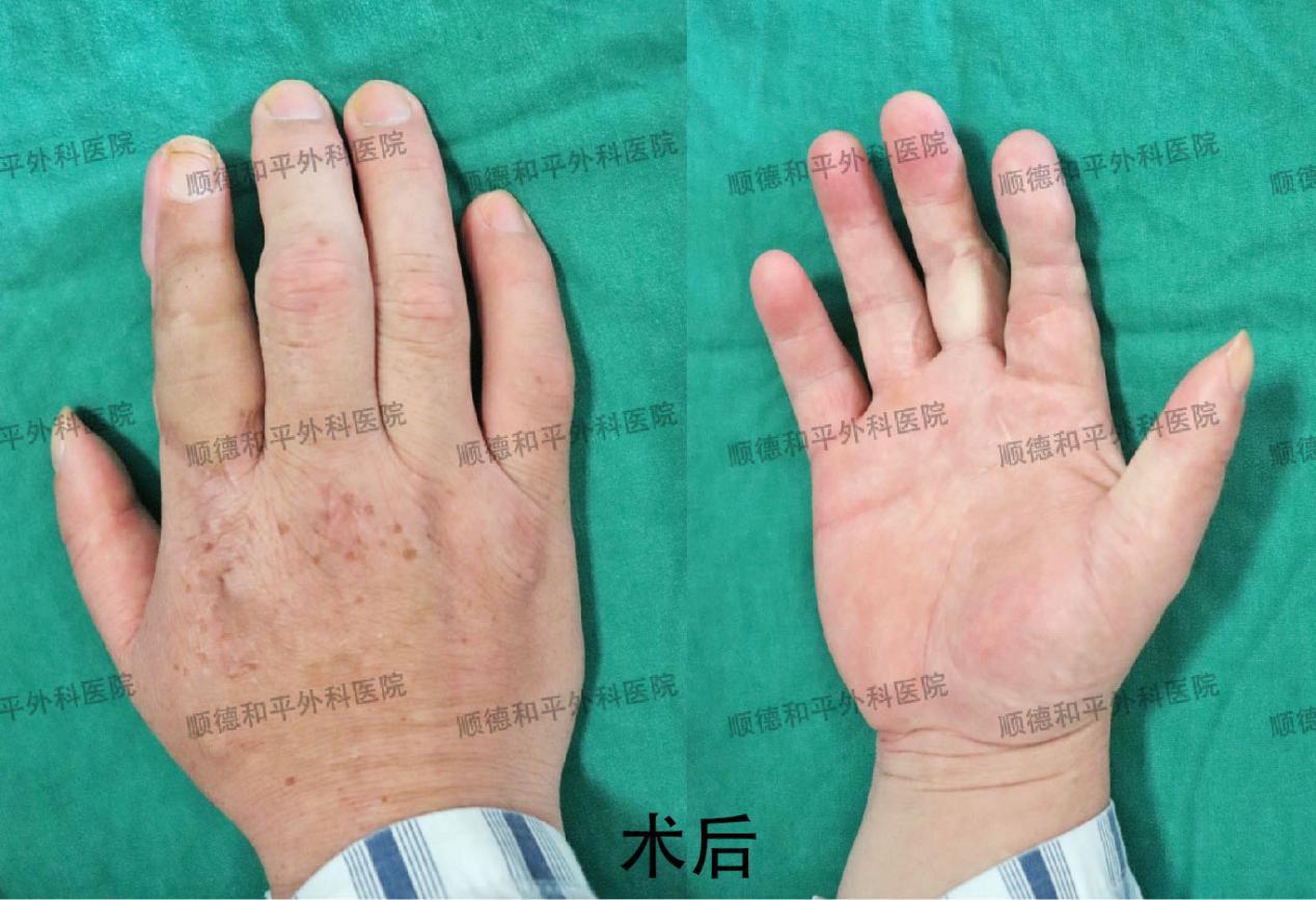 新疆患者失去手指心生自卑，遠赴廣東手指再造＿手外科醫(yī)院咨詢(圖2)