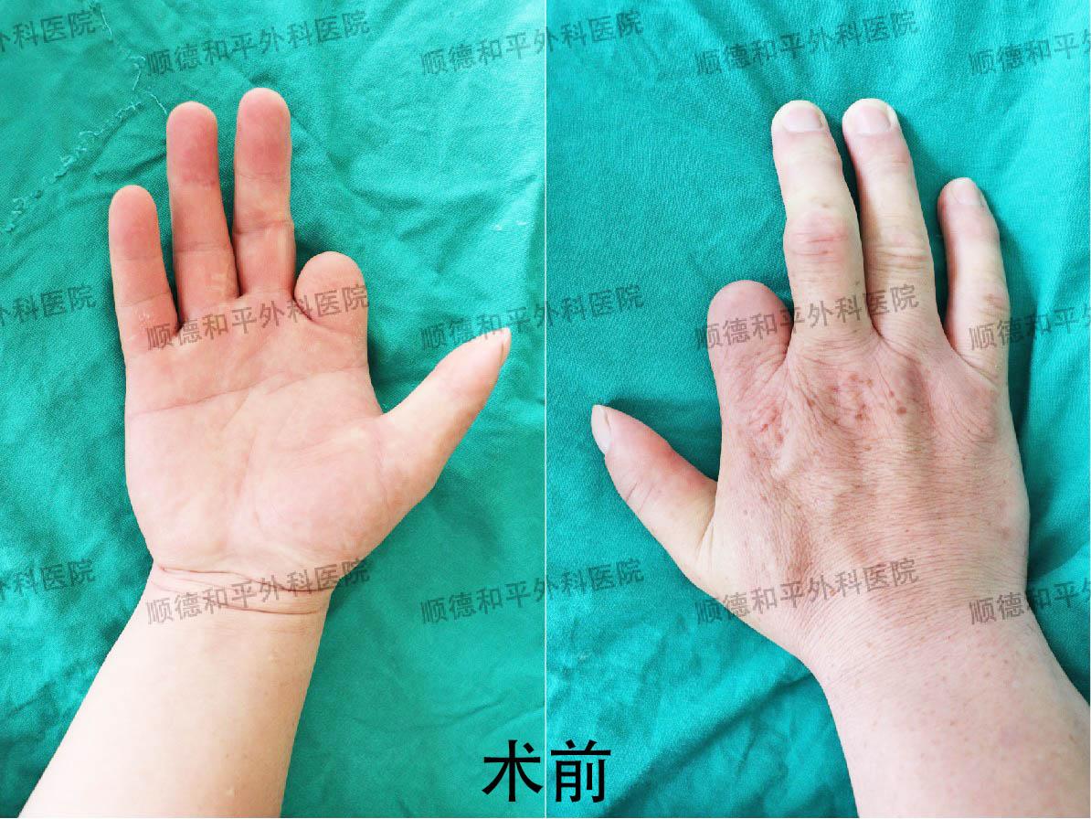 新疆患者失去手指心生自卑，遠赴廣東手指再造＿手外科醫(yī)院咨詢(圖1)